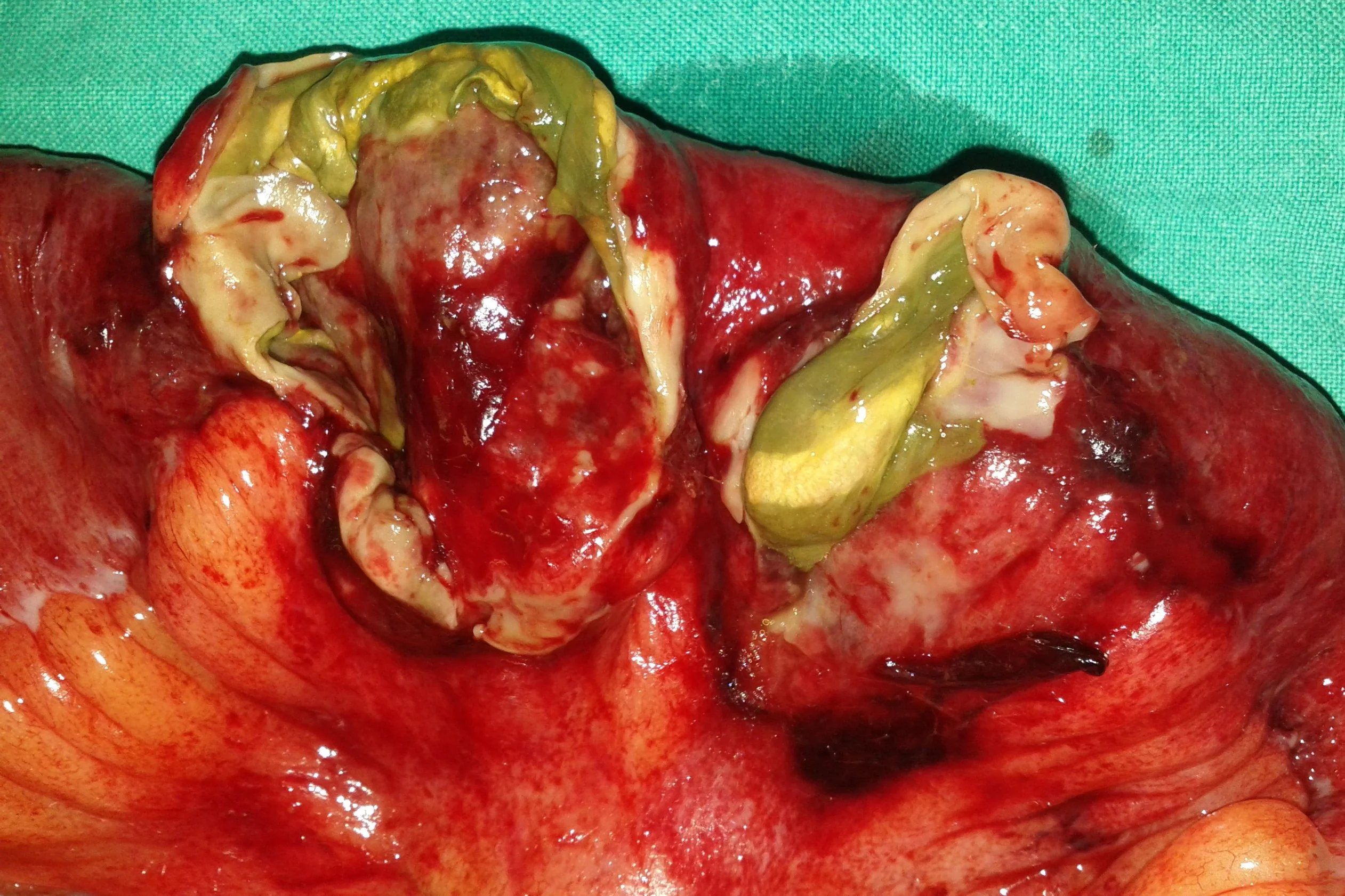 PERFORATION TERMINAL ILEUM