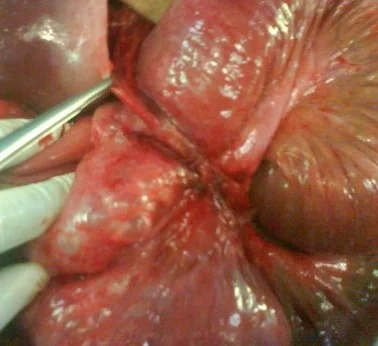 SMALL BOWEL VOLVULUS