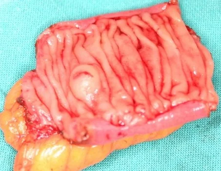 SUBMUCOSAL ANGIODYSPLASIA