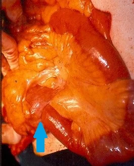 SMALL BOWEL ADENOCARCINOMA