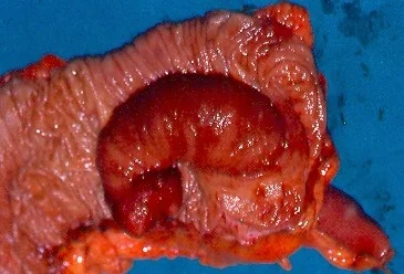 SMALL BOWEL ADENOCARCINOMA