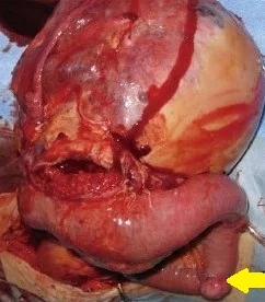 SMALL BOWEL ANGIOSARCOMA