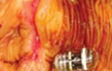 CAPSULE RETENSION