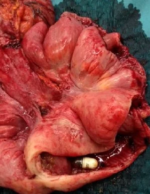 CAPSULE RETENSION - PERFORATION