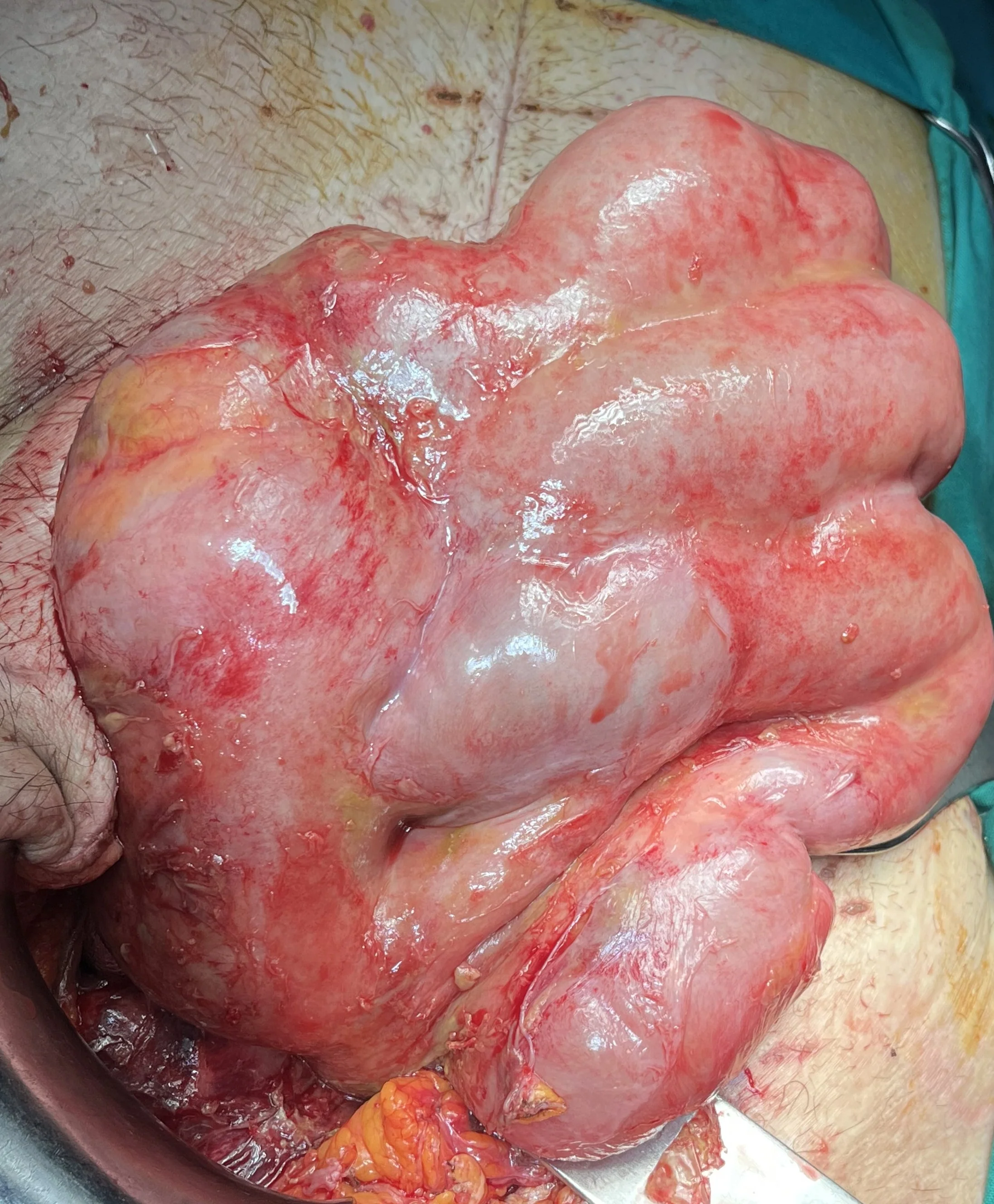 ABDOMINAL COCOON