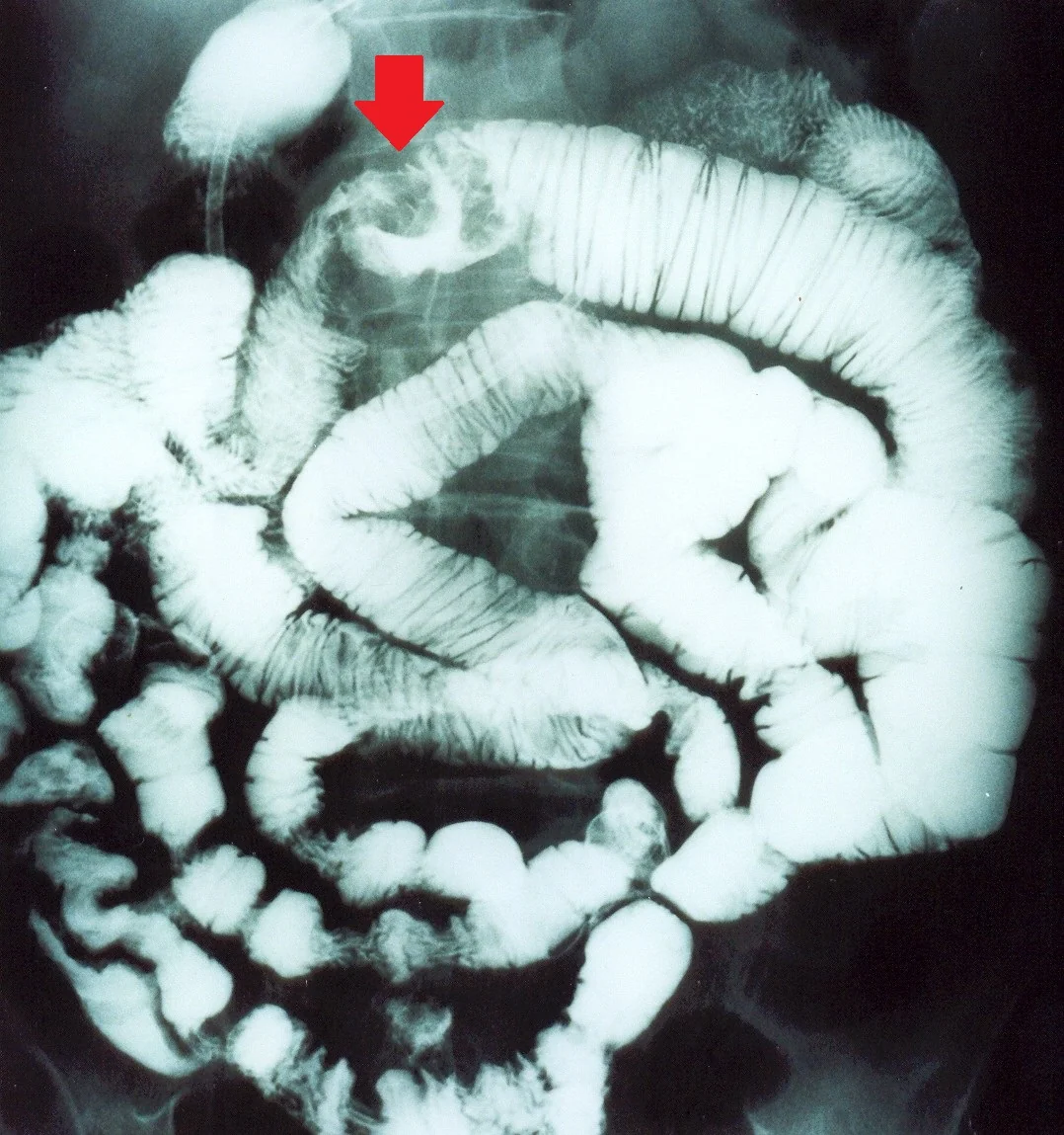 SMALL BOWEL NEUROENDOCRINE CARCINOMA
