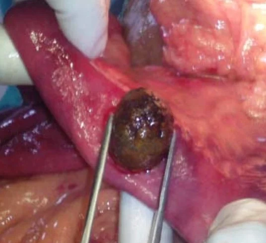 GALLSTONE ILEUS