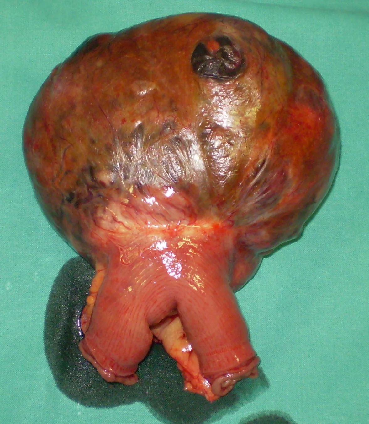 SMALL BOWEL GIST