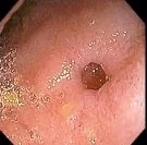ILEAL DIVERTICULOSIS