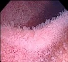 ILEAL VILLI