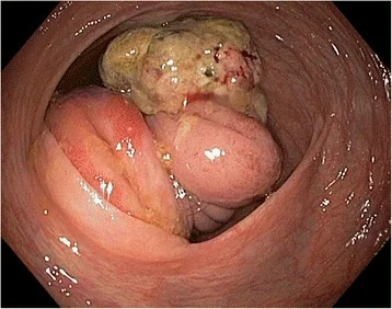 ILEOCAECAL INTUSSUSCEPTION