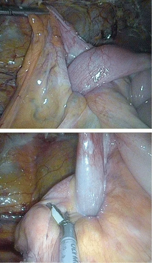 ILEOCAECAL INTUSSUSCEPTION