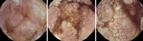 INTESTINAL LYMPHANGIECTASIA
