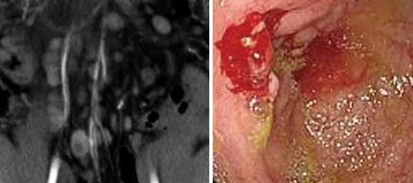 INTESTINAL LYMPHOMA