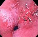 INTESTINAL METAPLASIA