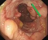 INTESTINAL TUBERCULOSIS