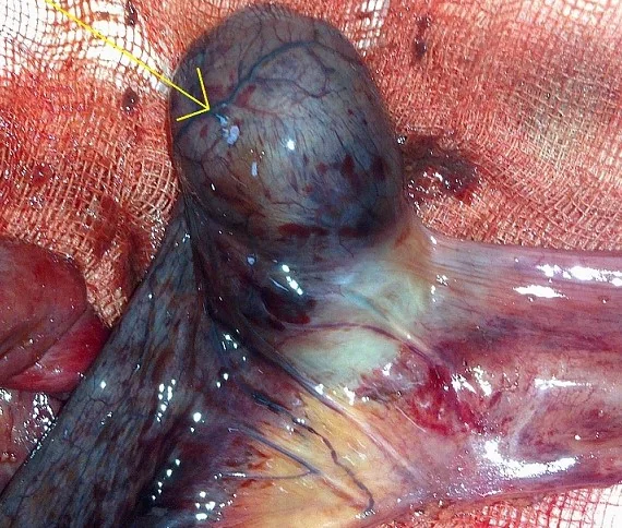 INVERTED MECKEL'S DIVERTICULUM