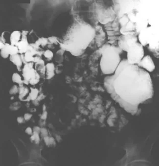 JEJUNAL DIVERTICULOSIS
