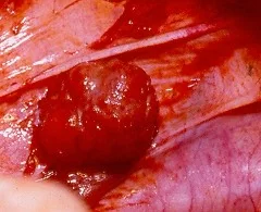 SMALL BOWEL LEIOMYOSARCOMA
