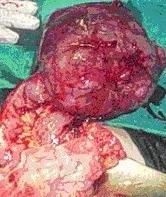 MALIGNANT SMALL BOWEL GIST