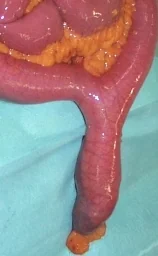 MECKEL'S DIVERTICULUM