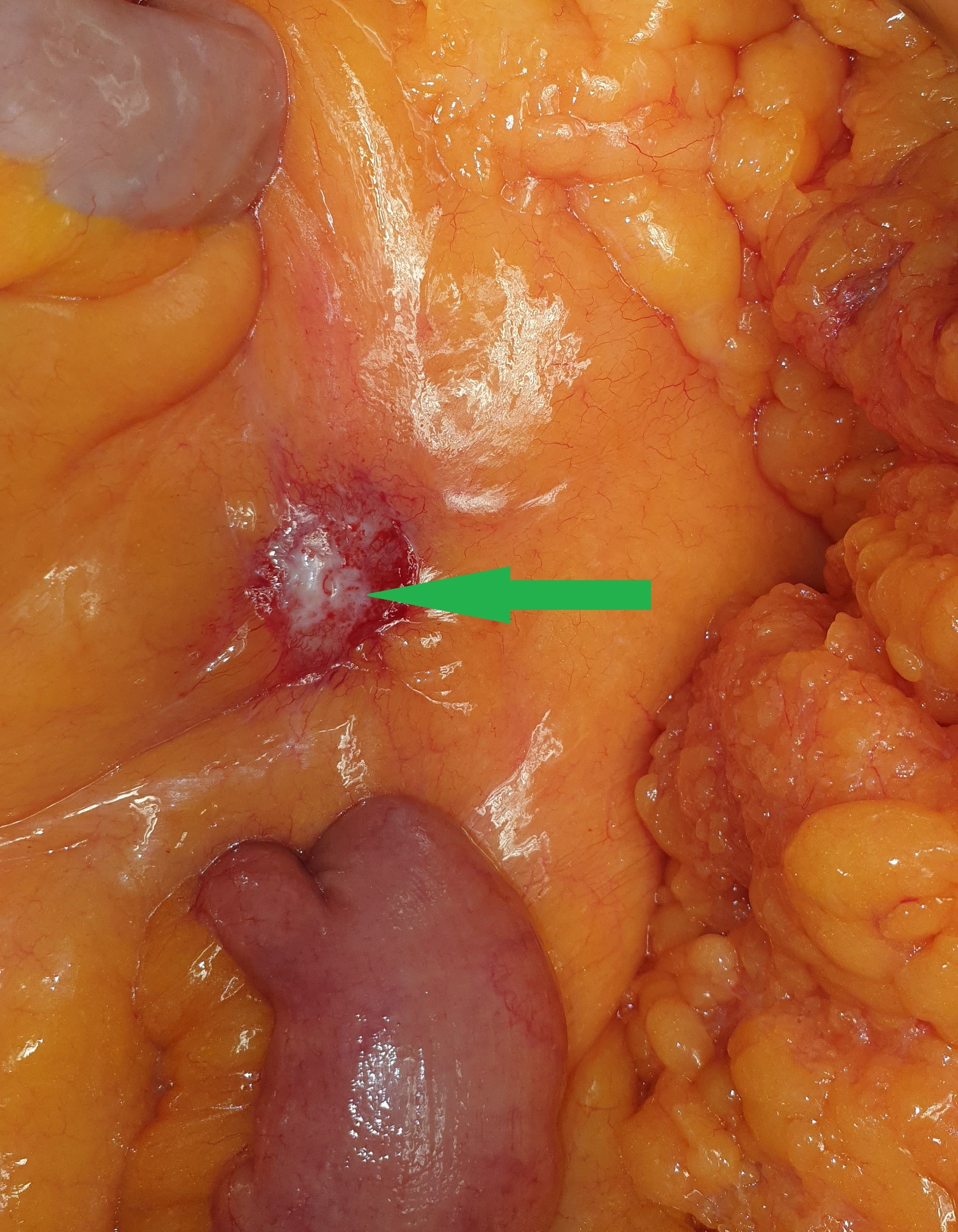 NEUROENDOCRINE TUMOR METASTASIS