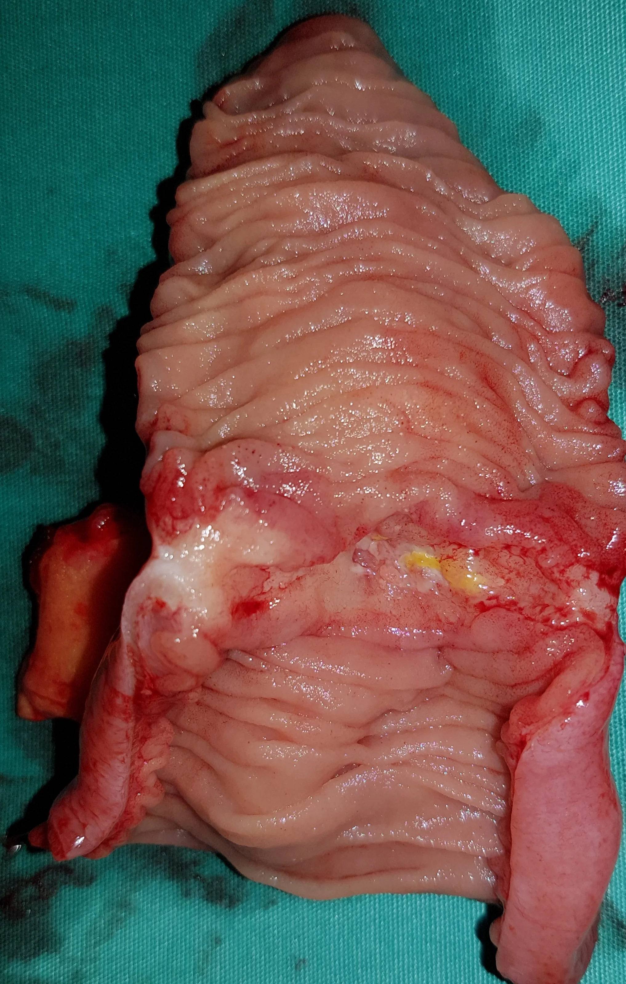 JEJUNAL CARCINOMA