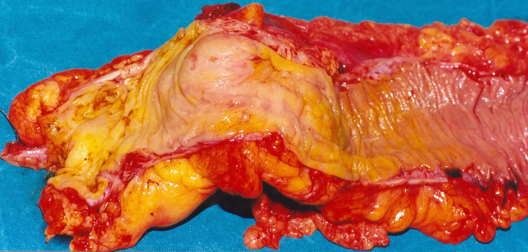 SMALL BOWEL NEUROENDOCRINE TUMOR
