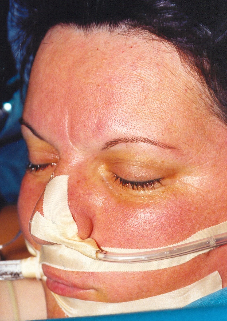 FACE FLUSHING - NEUROENDOCRINE TUMOR