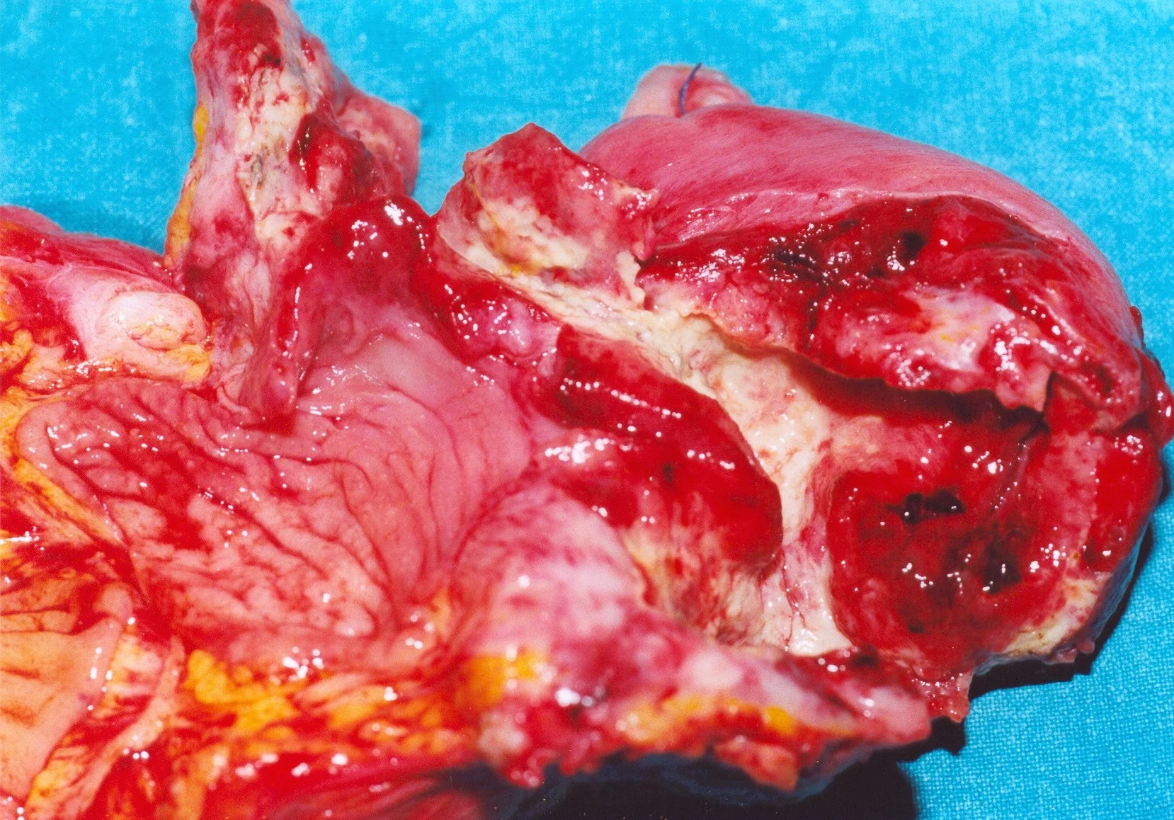 NEUROENDOCRINE TUMOR