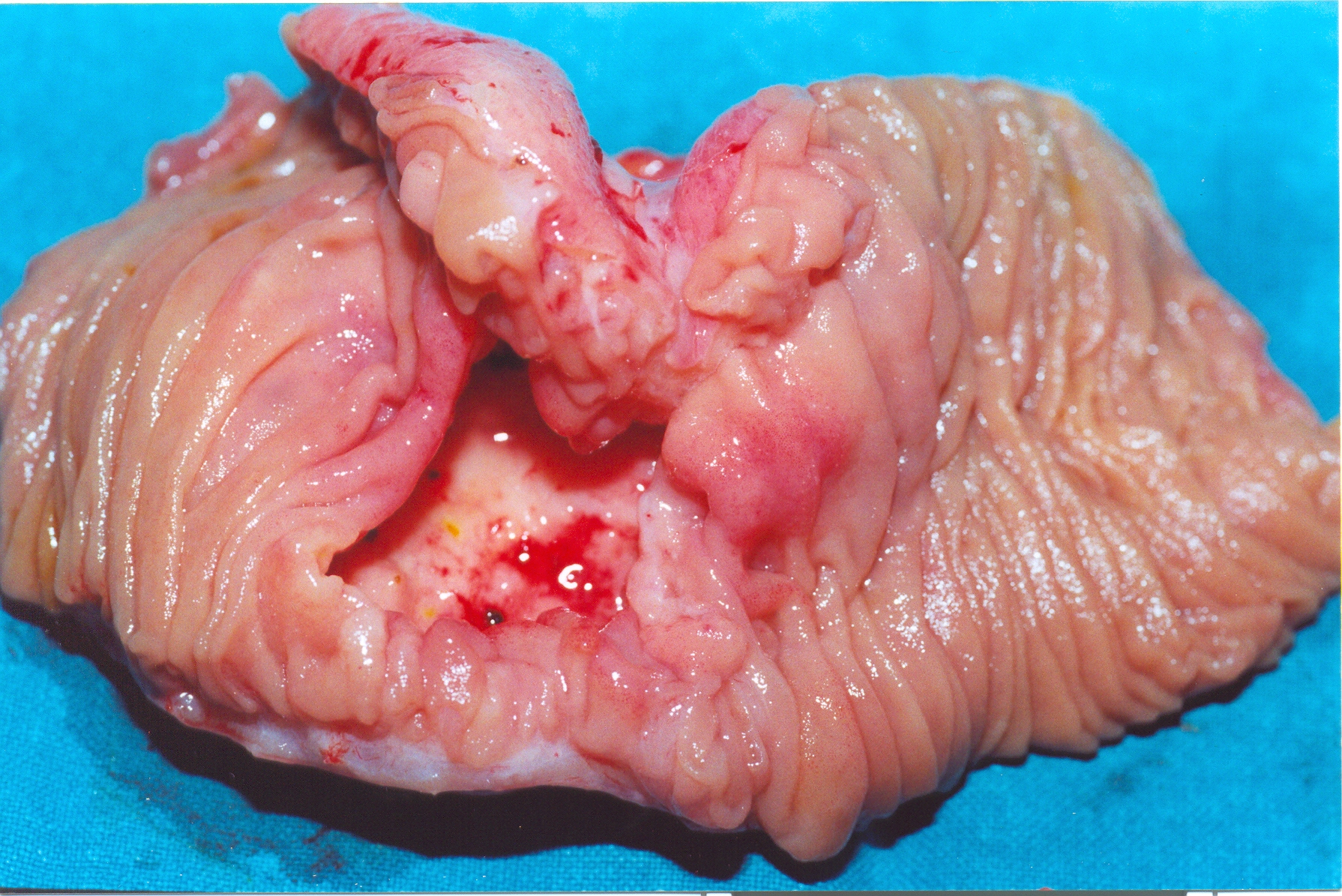NEUROENDOCRINE TUMOR
