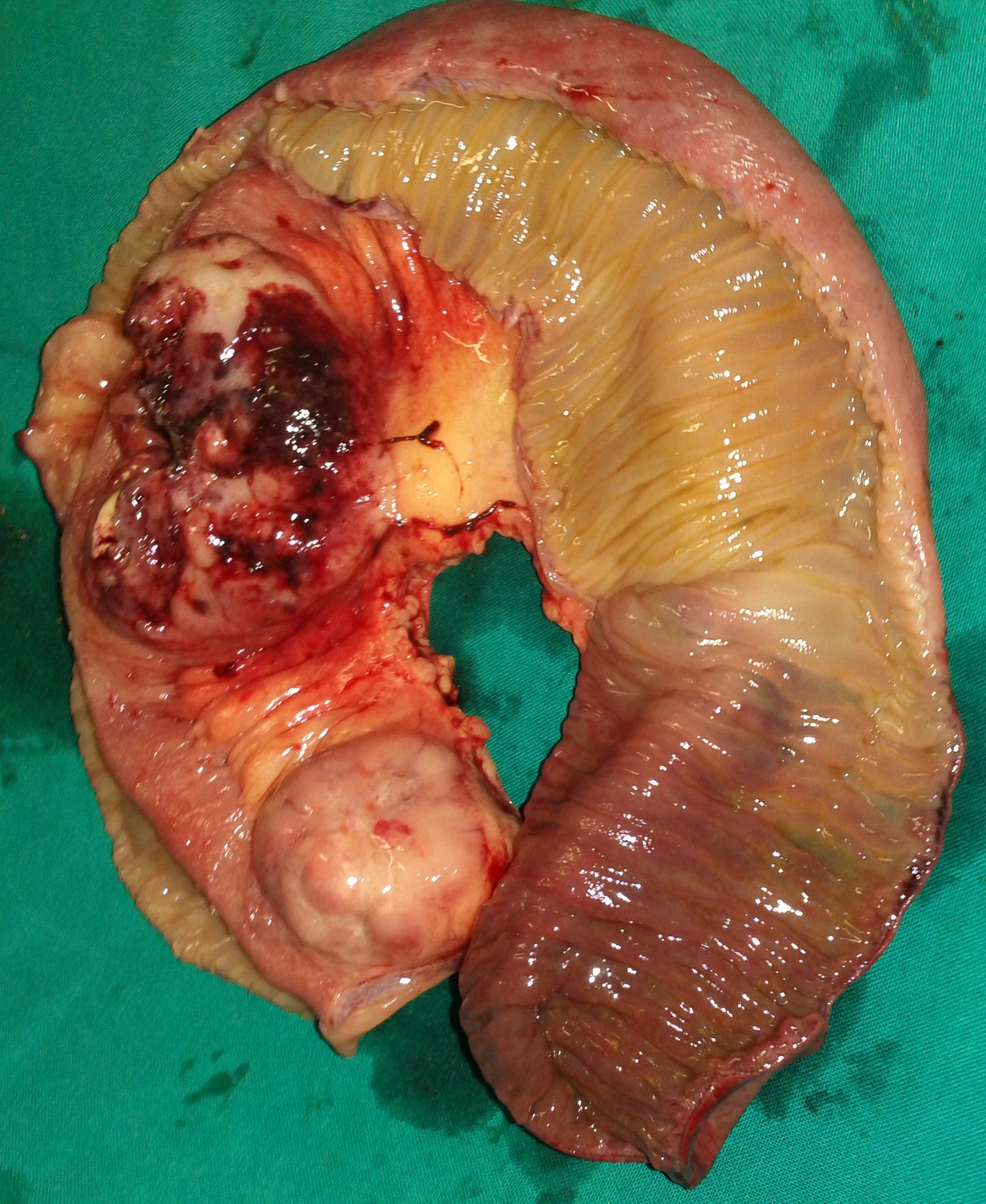 NON HODGKIN'S LYMPHOMA