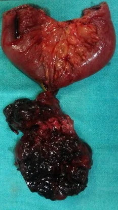ILEAL NEUROFIBROMA