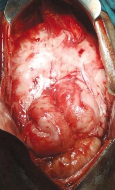 SCLEROSING PERITONITIS