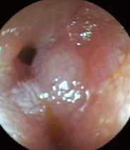 SMALL BOWEL ADENOCARCINOMA