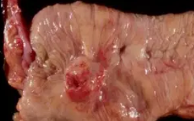 SMALL BOWEL CARCINOID