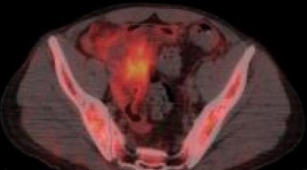 SMALL BOWEL CHLOROMA 