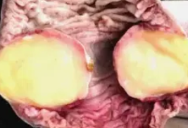 SMALL BOWEL LIPOMA