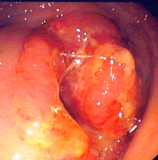TERMINAL ILEITIS-CAECAL CARCINOMA