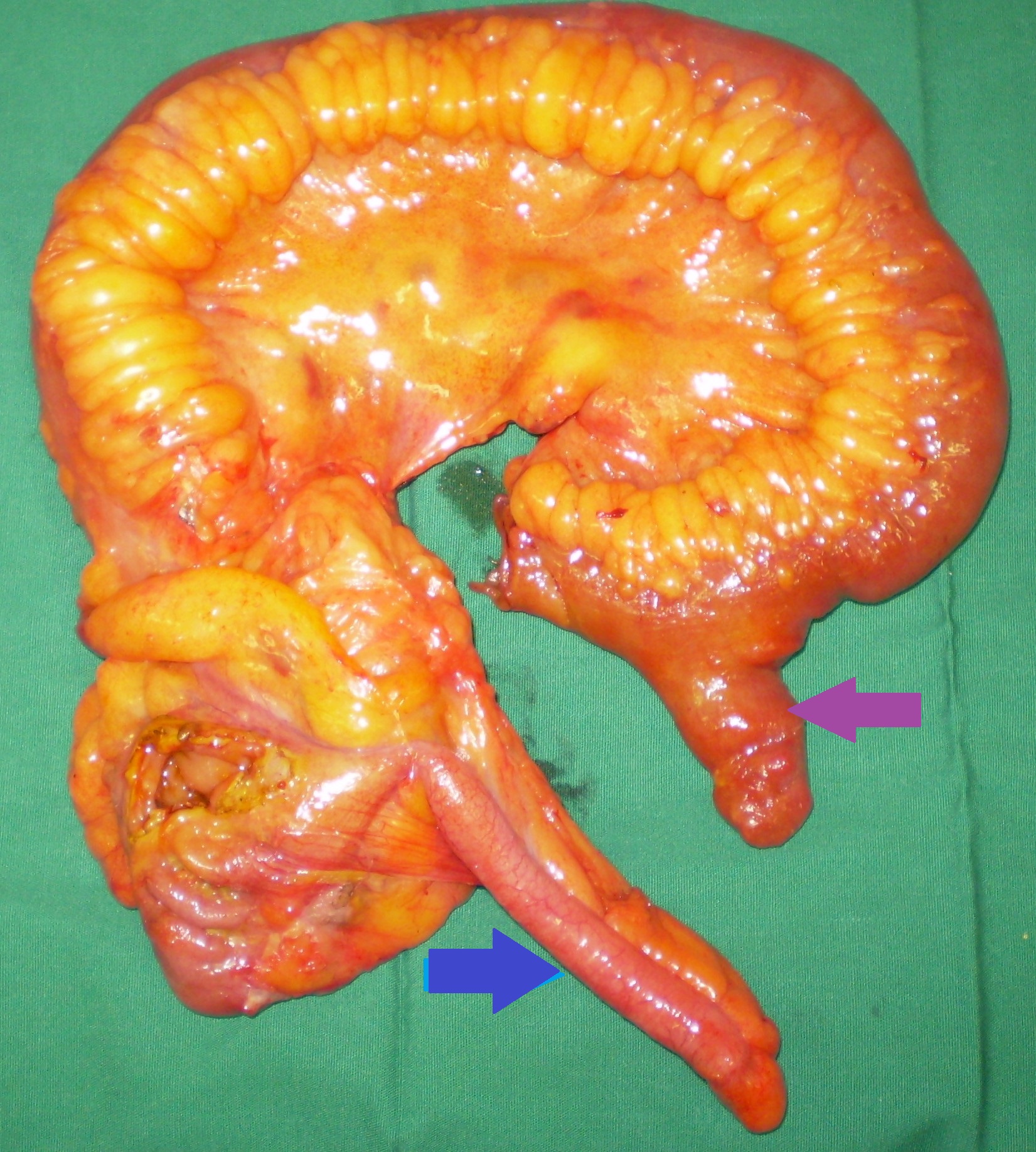 ILEAL TUMOR