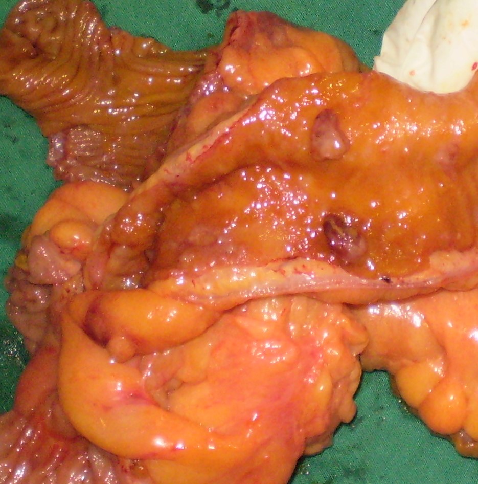 ILEAL ADENOCARCINOMA
