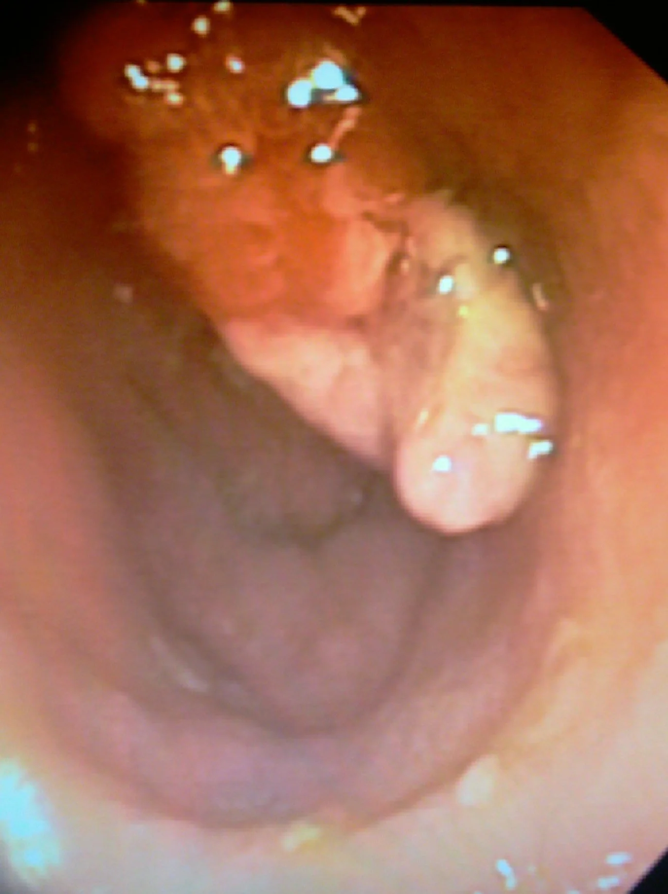 VASCULAR TUMOR ILEUS