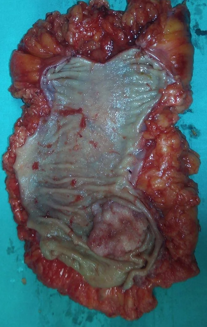 RECTAL CARCINOMA