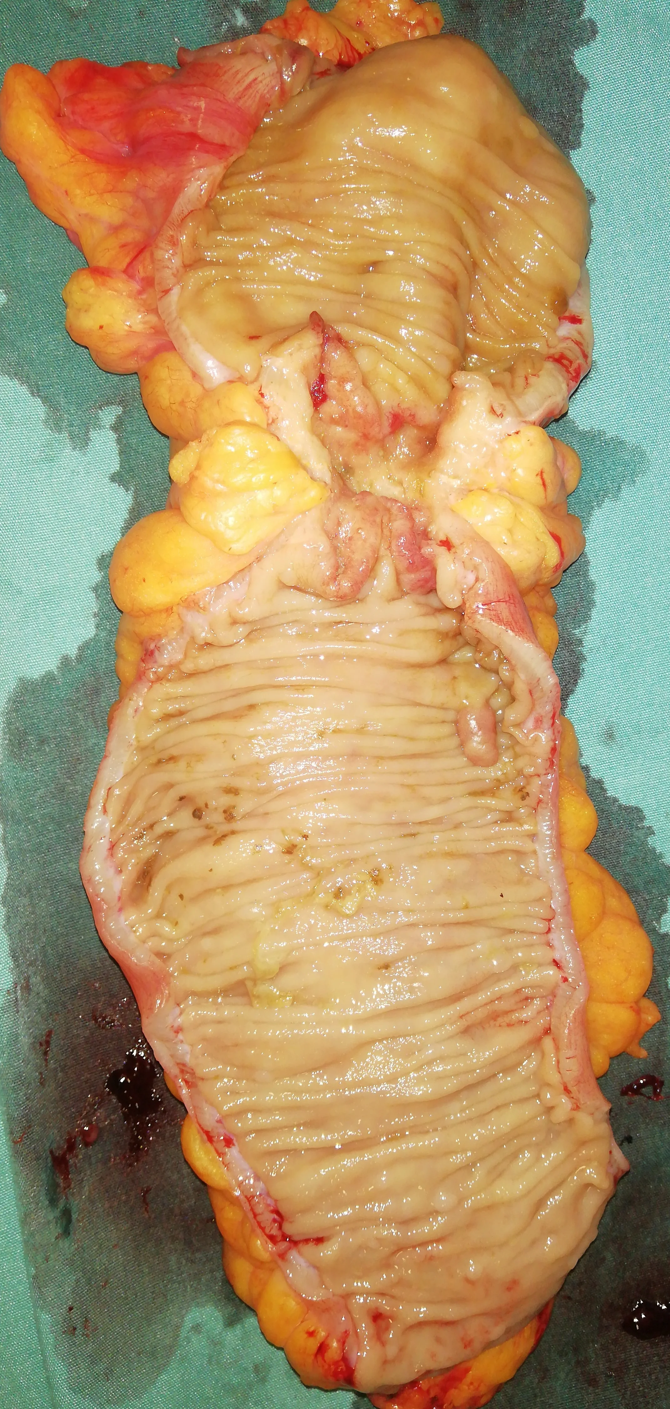 DESCENDING COLON CARCINOMA 