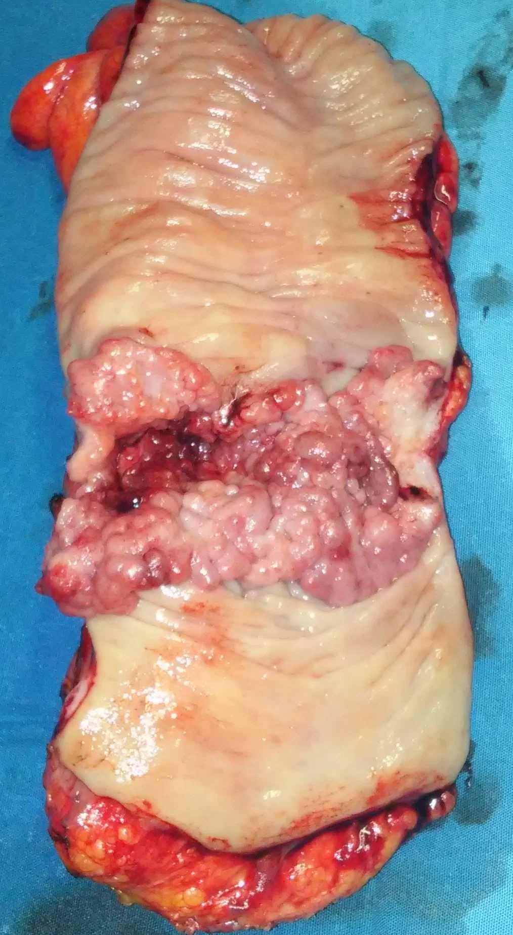RECTAL CARCINOMA