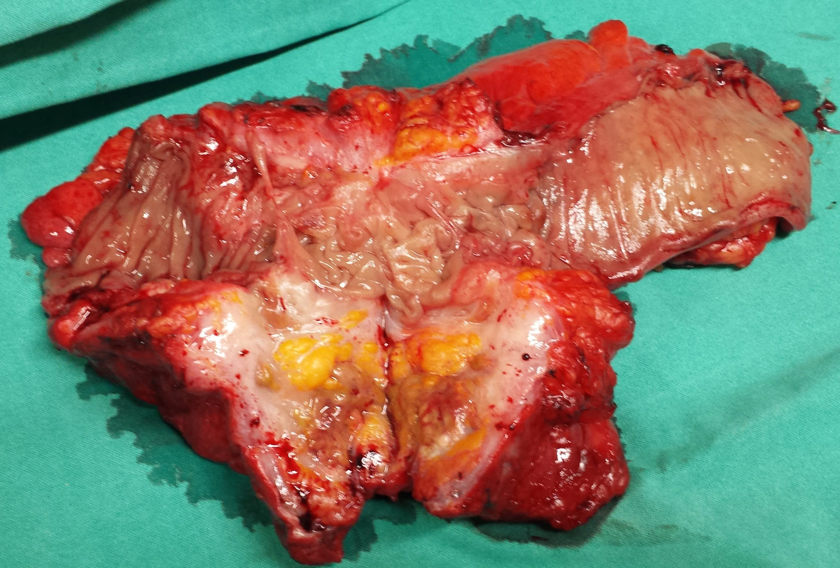 EXTRALUMINAL RECURRENCE OF SIGMOID CARCINOMA