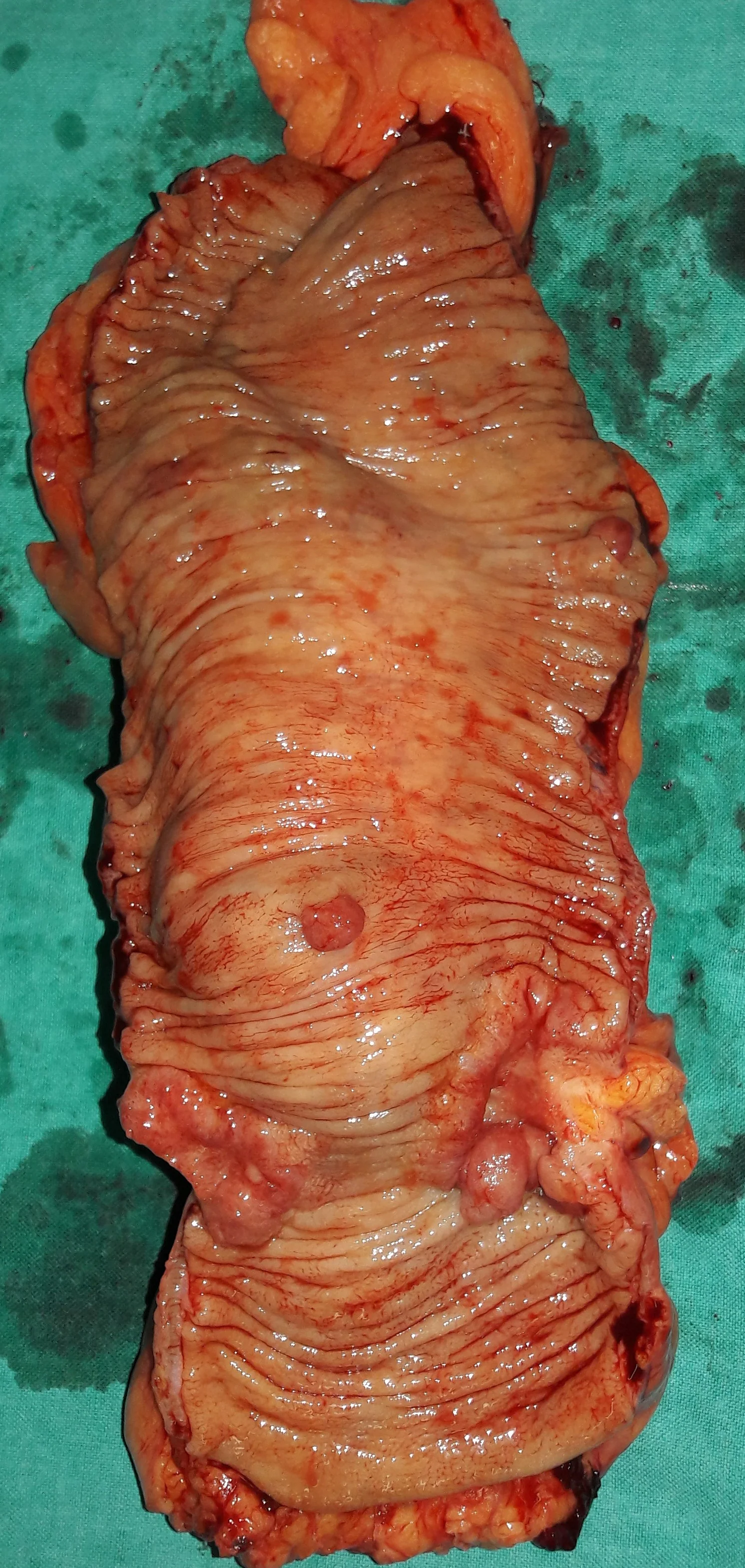 DOUBLE RECTAL CARCINOMA
