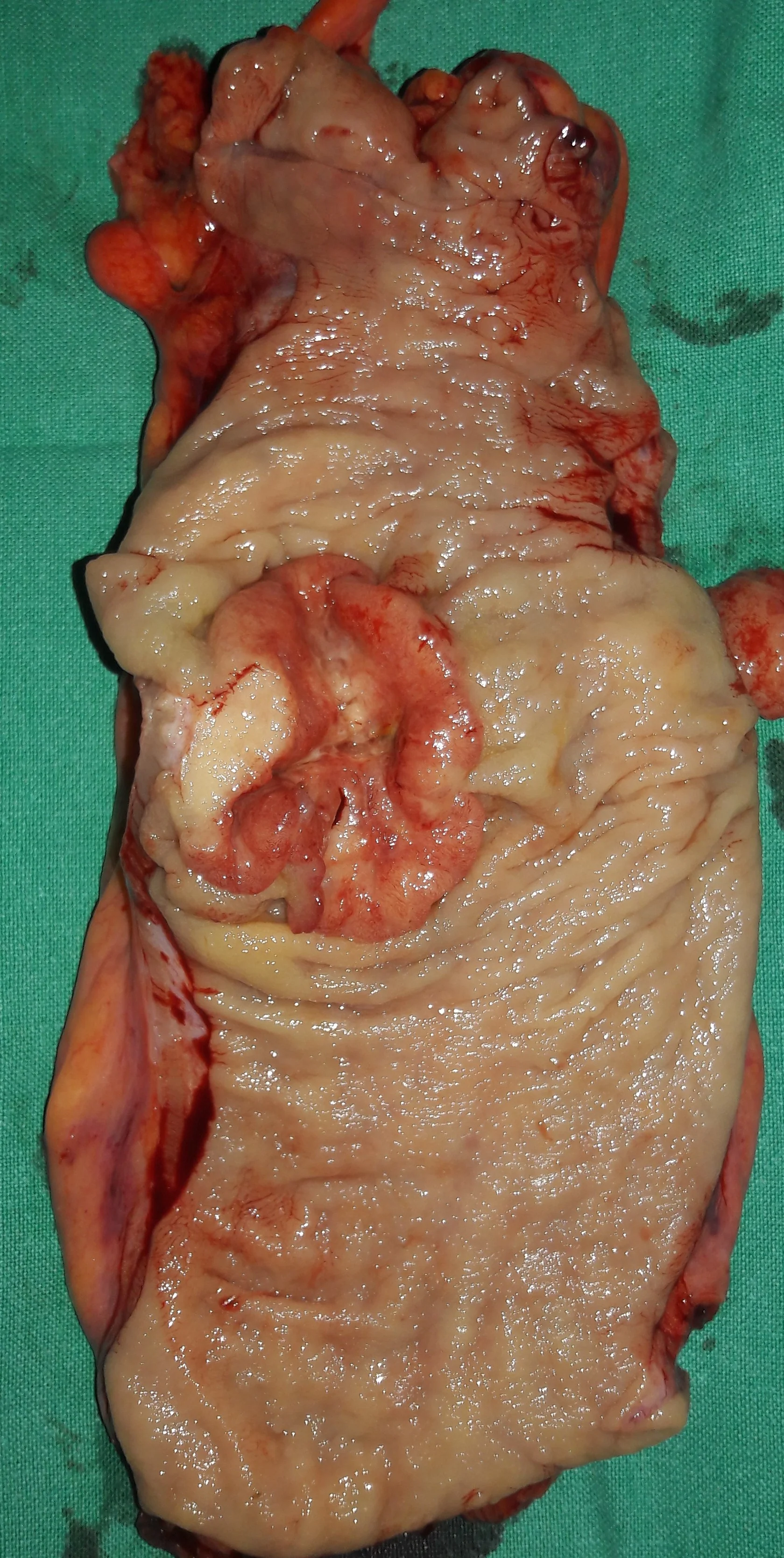 RECTAL CARCINOMA