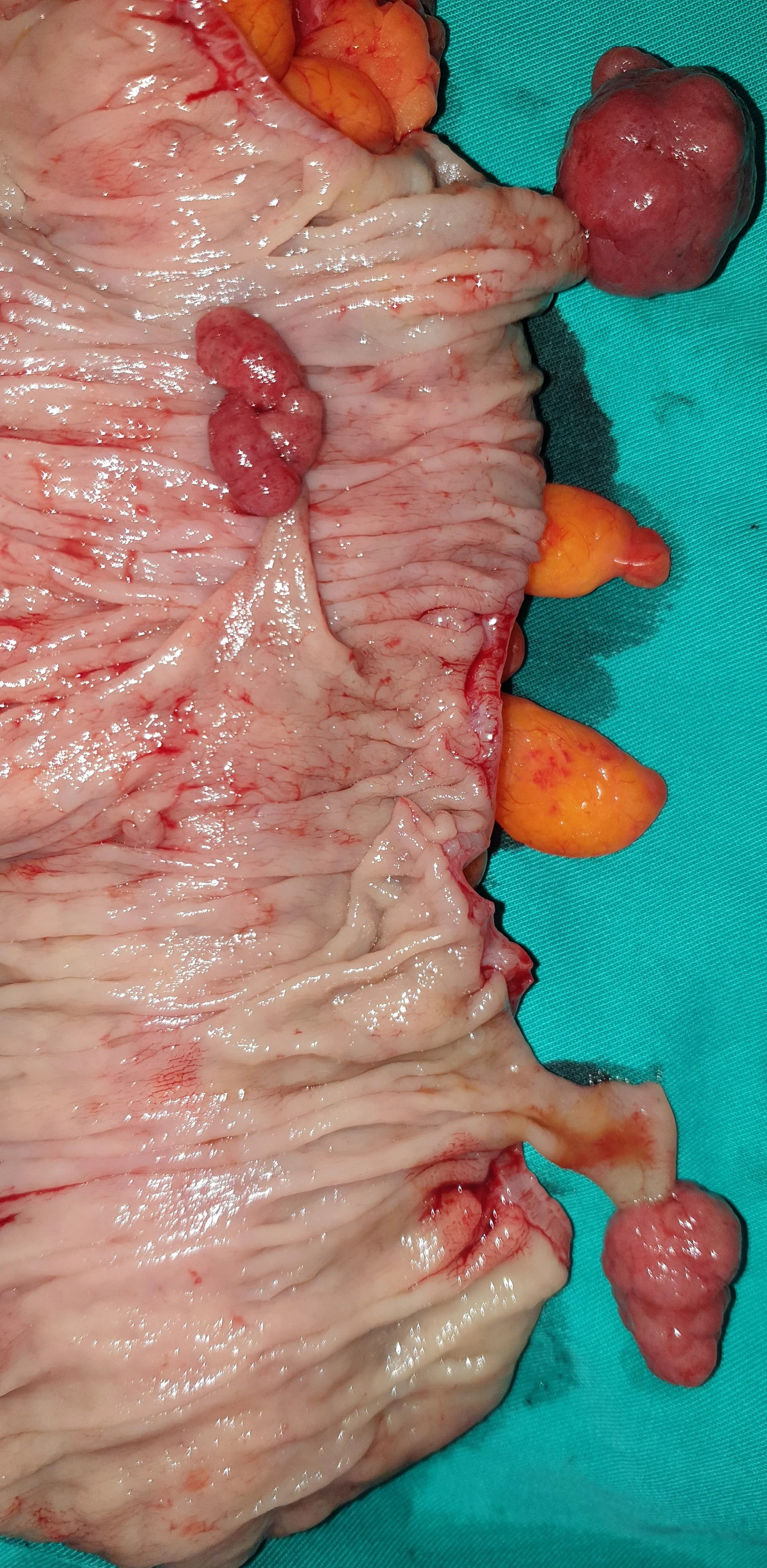 COLONIC POLYPS