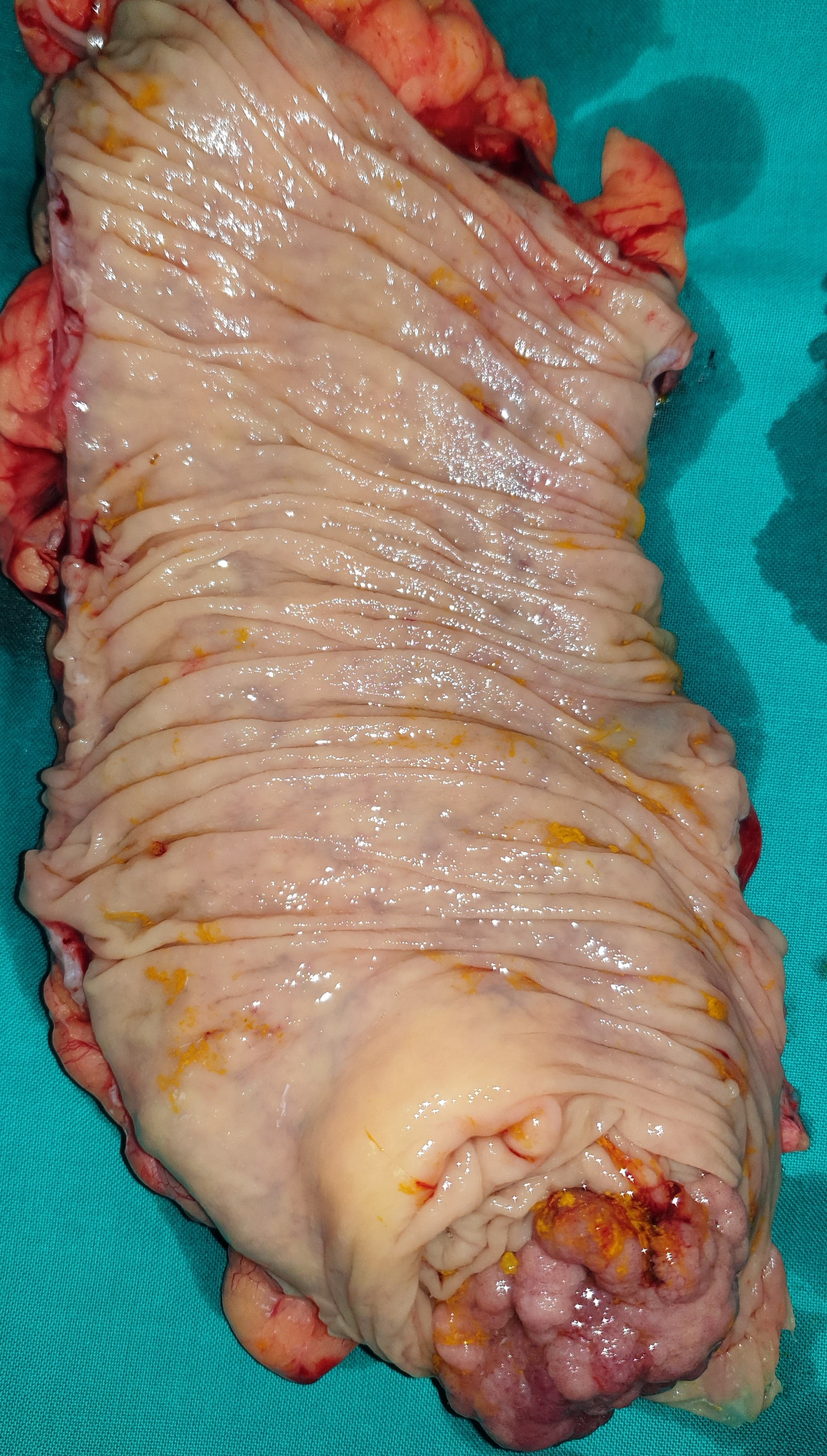 ILEOCECAL VALVE CARCINOMA